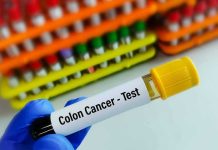 Doctors Missed CANCER — She Had Hours Left Gloved hand holding colon cancer test tube