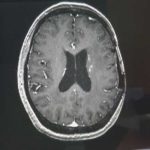 Alzheimer's Breakthrough: Brain's 'Clean-Up Crew' Reactivated