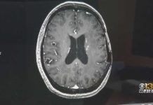 Alzheimer's Breakthrough: Brain's 'Clean-Up Crew' Reactivated