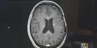 Alzheimer's Breakthrough: Brain's 'Clean-Up Crew' Reactivated