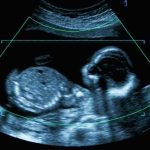 24-Week Abortion Limit Scrapped — Doctor Decides Fetal ultrasound scan image