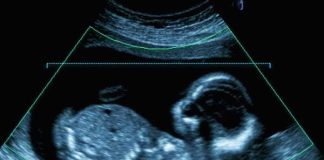 Fetal ultrasound scan image
